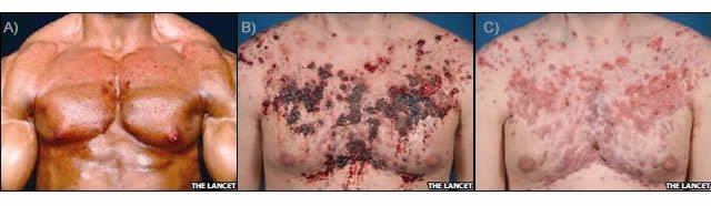 Acné oui Stéroïdes